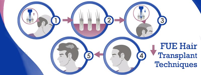 The Most Advanced FUE Hair Transplant Techniques