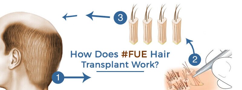 How Does FUE Hair Transplant Work?