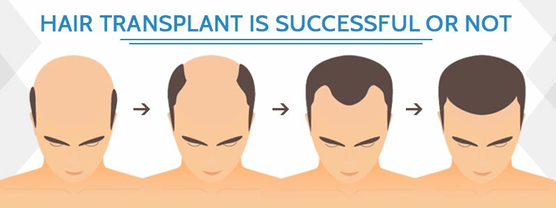 Hair Transplant is Successful or Not