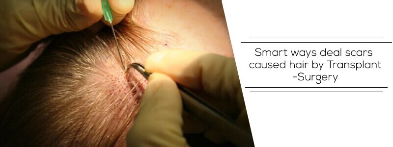 Smart Ways to Deal with the Scars Caused By Hair Transplant Surgery