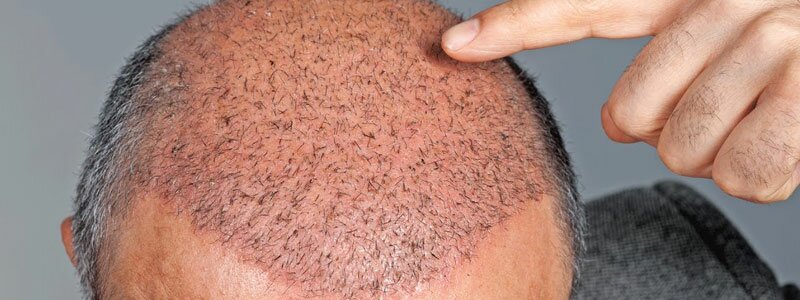 Myths About the Side Effects of Hair Transplant