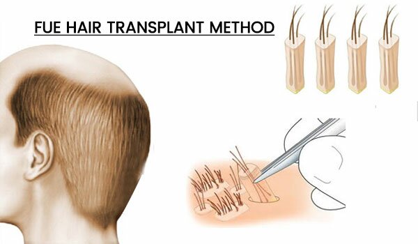 FUE Hair Transplant Method in Delhi
