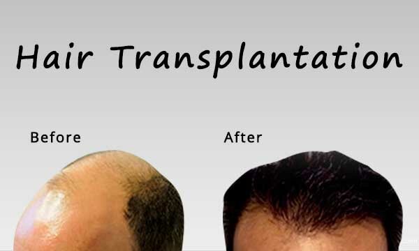 Hair Transplant Surgery for Everyone