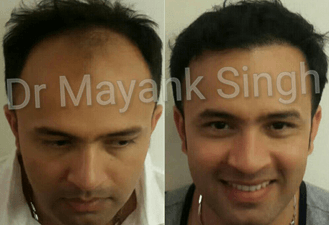 Best Hair Transplant in Delhi NCR