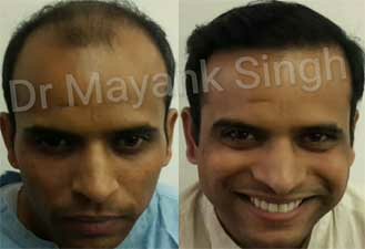 Hair Surgery in Delhi