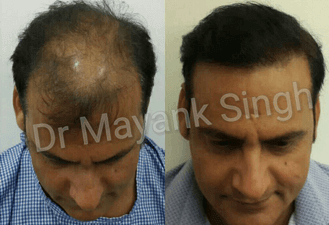 Hair Transplant Delhi NCR