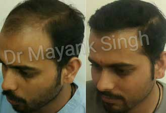 Hair Transplant in Delhi NCR