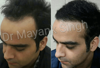 Hair Transplant Surgery Delhi